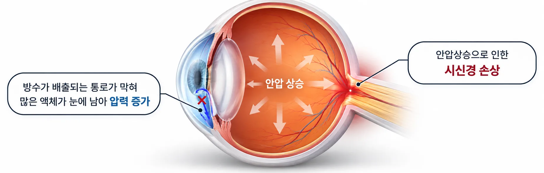 안압이 올라가 시신경을 누르는 과정을 그린 안구 단면 안내 그림