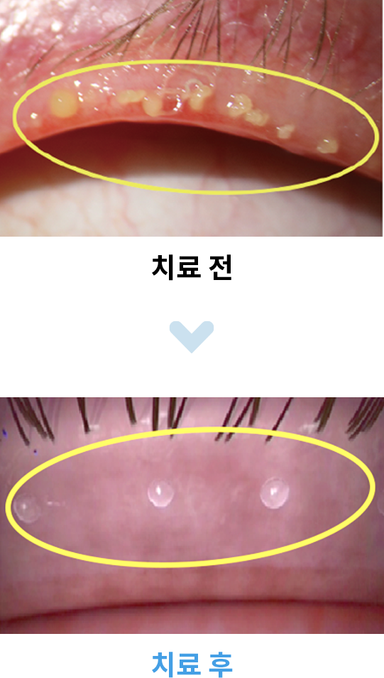 아쿠아셀 IPL 레이저 치료 전후 눈꺼풀 마이봄샘 비교 사진